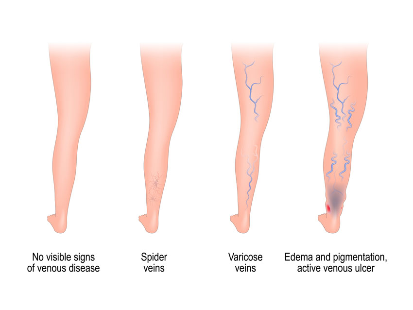 vein disease in legs