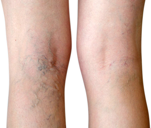 Cure For Spider Veins