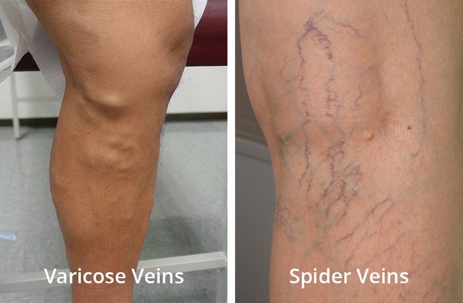 Varicose And Spider Veins