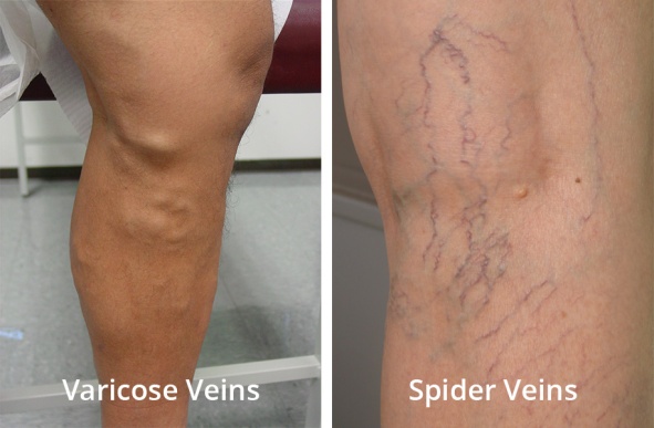 Varicose And Spider Veins.jpg