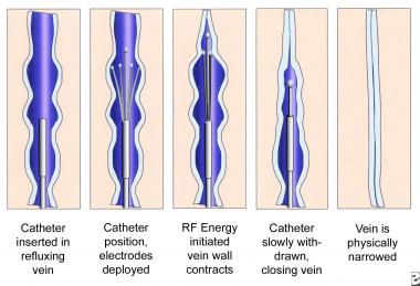 Radiofrequency Ablation Veins