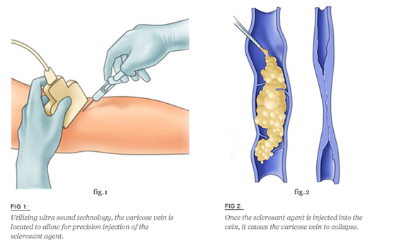 Sclerotherapy Procedure